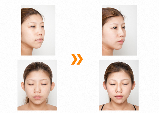 隆鼻(ヒアルロン酸注入)beforeafter