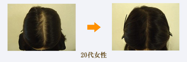 20代女性薄毛症例画像
