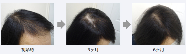 女性薄毛治療