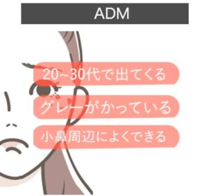 ADM…20代～30代で出てくる、グレーがかっている、小鼻周辺によくできる