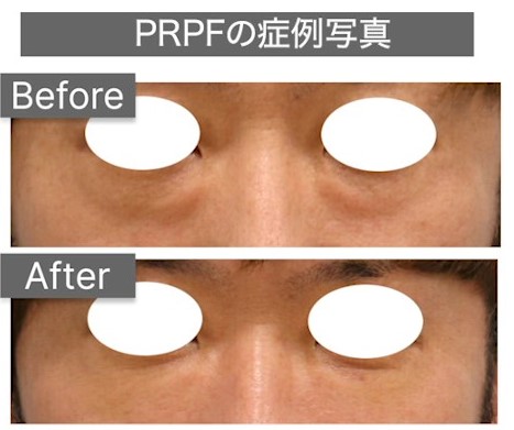 PRPFの症例写真