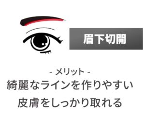 眉下切開、メリット：綺麗なラインを作りやすい皮膚をしっかり取れる