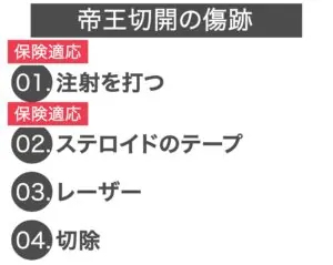 帝王切開の傷跡,01.注射を打つ、02.ステロイドのテープ、03.レーザー、04.切除