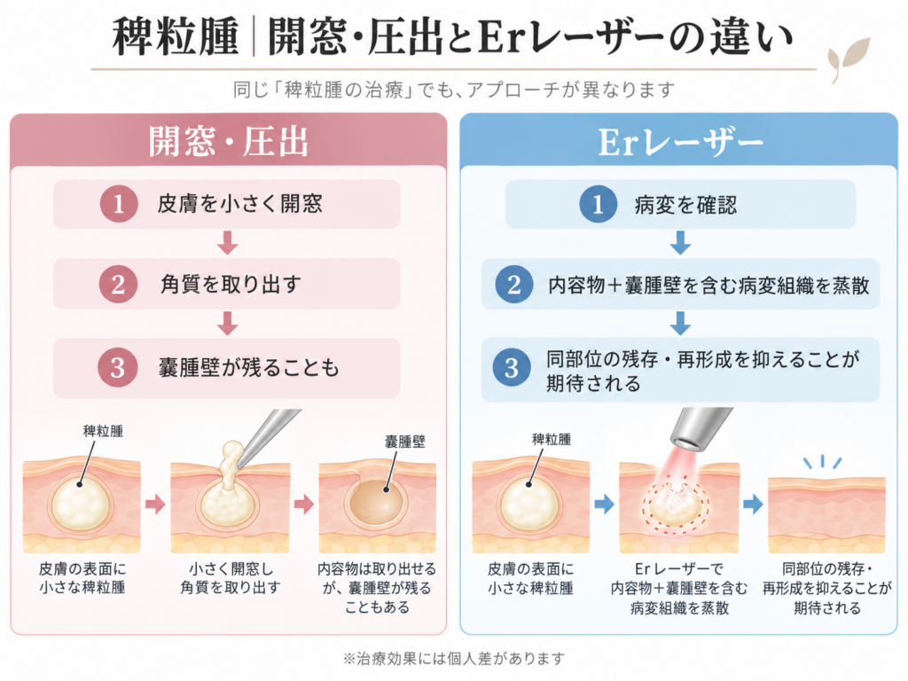 稗粒腫 レーザー 針 圧出 嚢腫壁 Er:YAG 違い