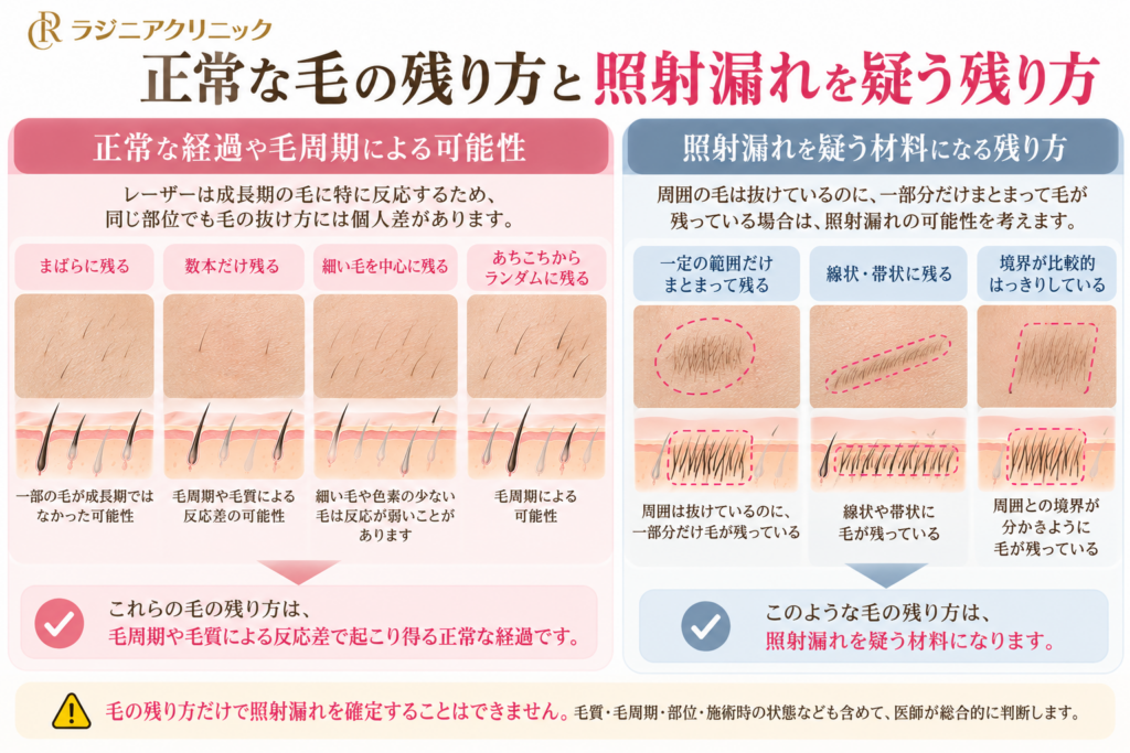 医療脱毛 照射漏れ 見分け方 毛の残り方