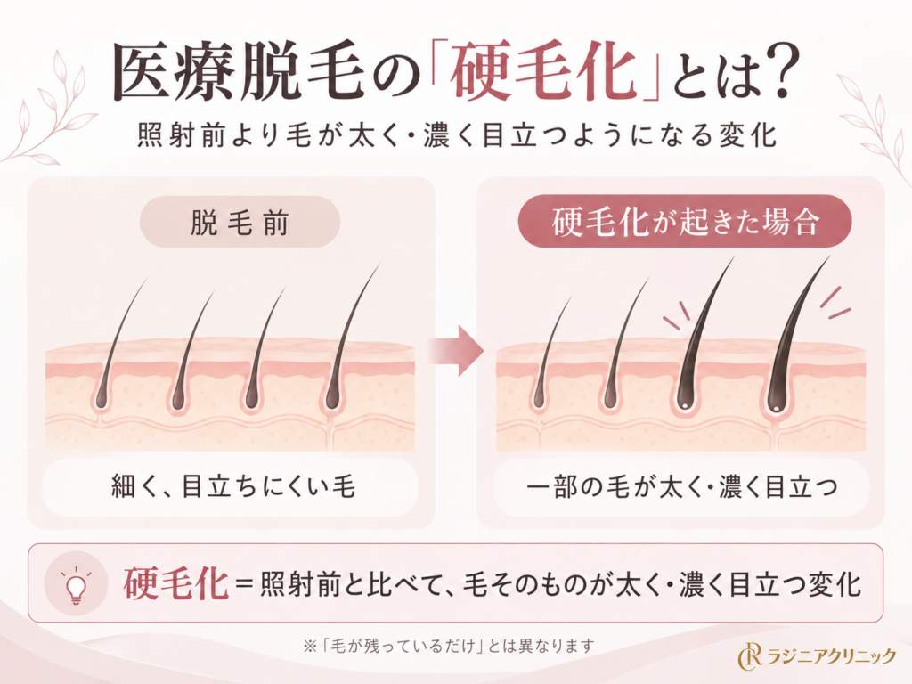 医療脱毛 硬毛化とは 毛が太く濃くなる変化